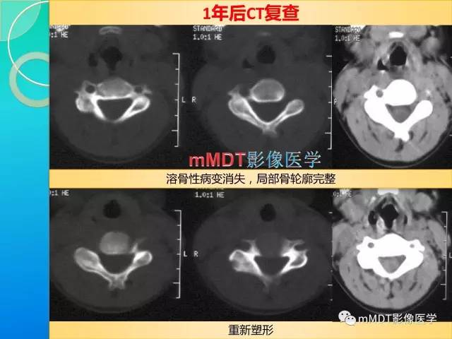 【PPT】不典型LCH诊断与鉴别诊断