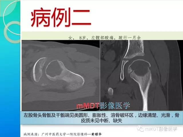 【PPT】不典型LCH诊断与鉴别诊断