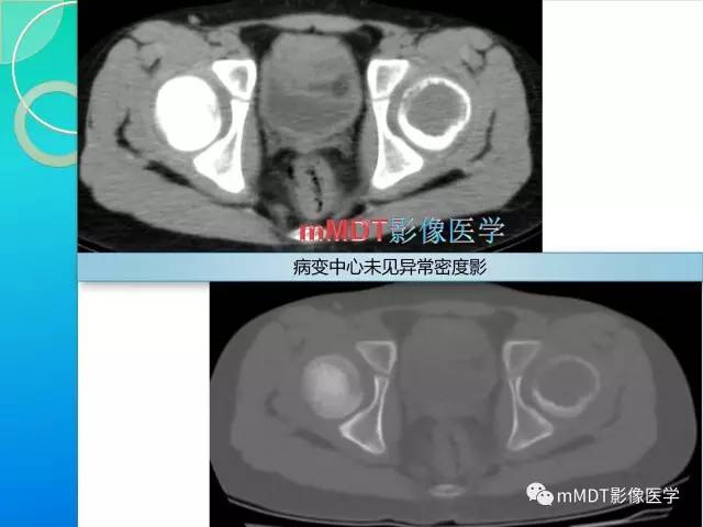 【PPT】不典型LCH诊断与鉴别诊断