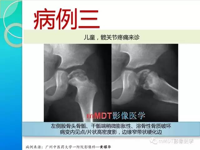 【PPT】不典型LCH诊断与鉴别诊断