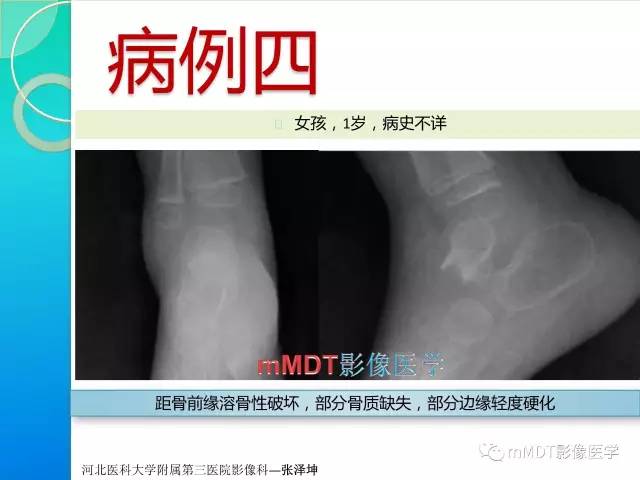 【PPT】不典型LCH诊断与鉴别诊断