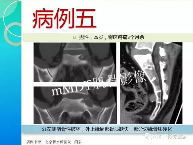 【PPT】不典型LCH诊断与鉴别诊断