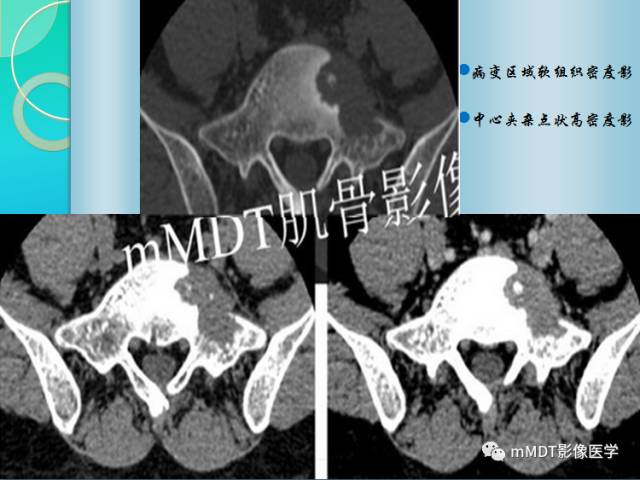 【PPT】不典型LCH诊断与鉴别诊断