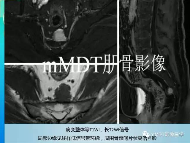 【PPT】不典型LCH诊断与鉴别诊断