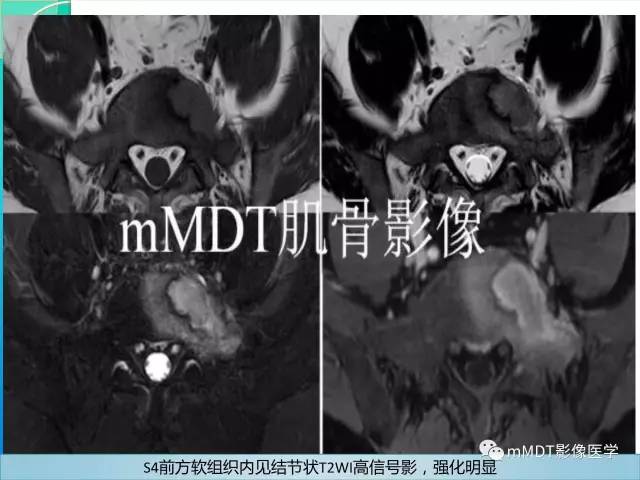【PPT】不典型LCH诊断与鉴别诊断