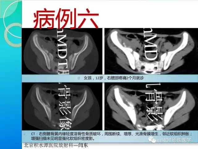 【PPT】不典型LCH诊断与鉴别诊断