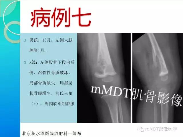 【PPT】不典型LCH诊断与鉴别诊断