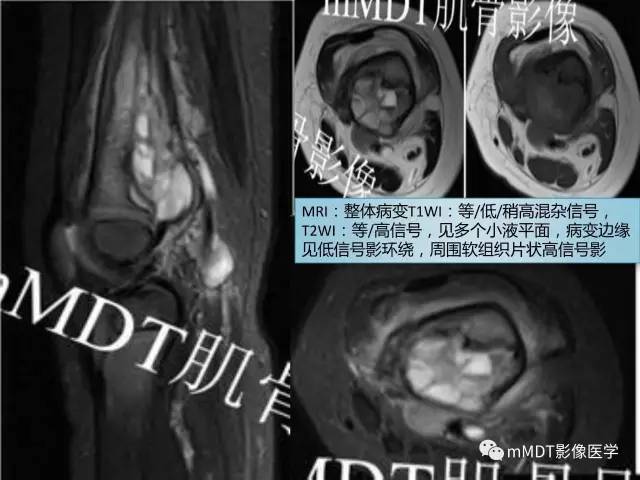【PPT】不典型LCH诊断与鉴别诊断
