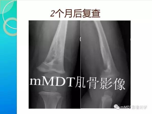 【PPT】不典型LCH诊断与鉴别诊断