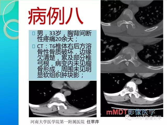 【PPT】不典型LCH诊断与鉴别诊断