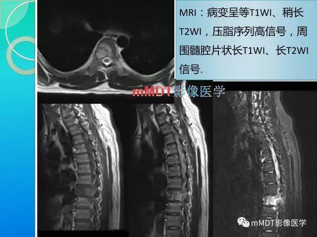 【PPT】不典型LCH诊断与鉴别诊断