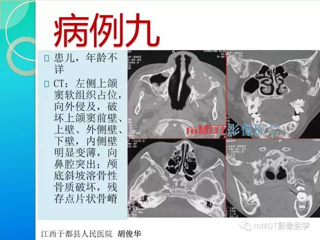 【PPT】不典型LCH诊断与鉴别诊断