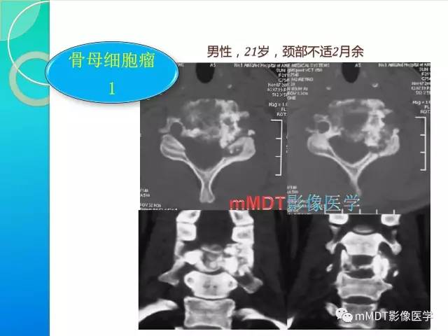 【PPT】不典型LCH诊断与鉴别诊断