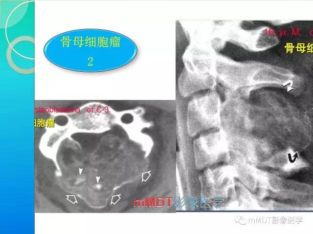 【PPT】不典型LCH诊断与鉴别诊断