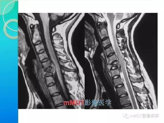 【PPT】不典型LCH诊断与鉴别诊断