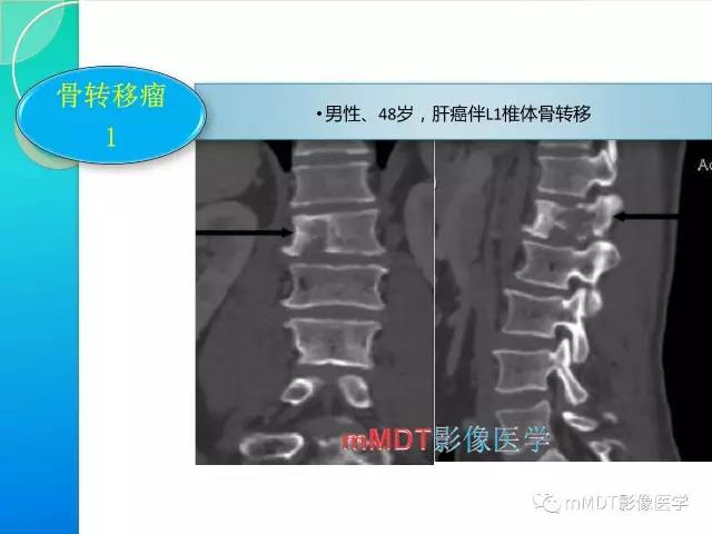 【PPT】不典型LCH诊断与鉴别诊断