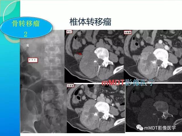 【PPT】不典型LCH诊断与鉴别诊断