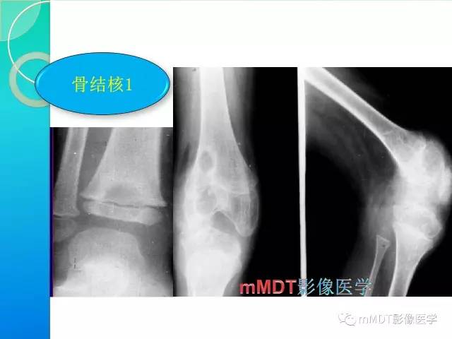 【PPT】不典型LCH诊断与鉴别诊断