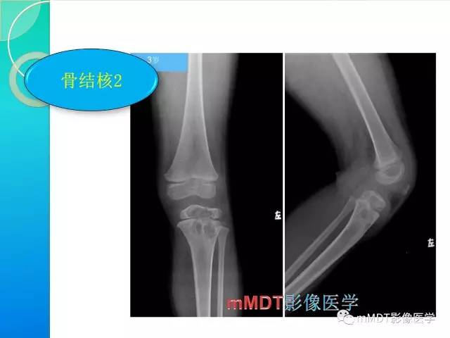 【PPT】不典型LCH诊断与鉴别诊断