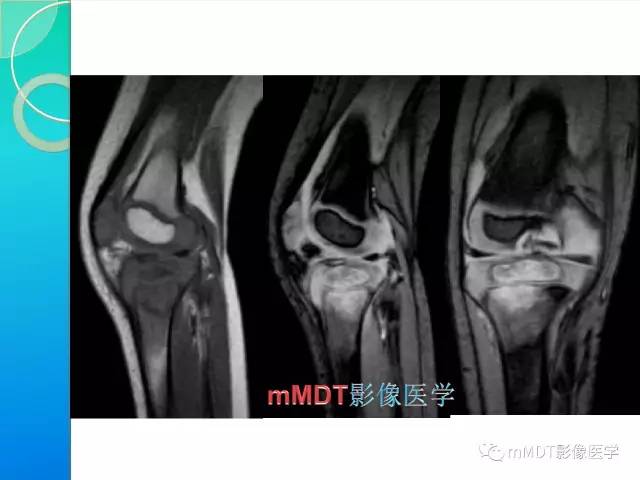 【PPT】不典型LCH诊断与鉴别诊断