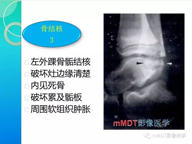 【PPT】不典型LCH诊断与鉴别诊断
