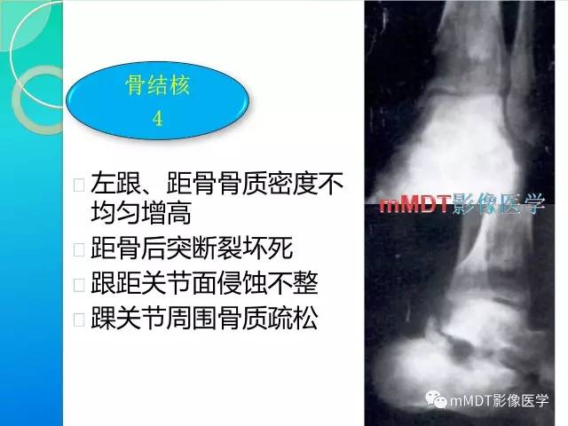 【PPT】不典型LCH诊断与鉴别诊断