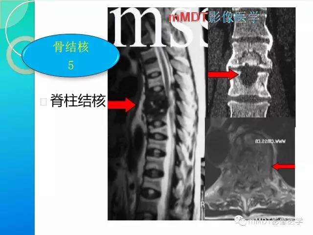 【PPT】不典型LCH诊断与鉴别诊断