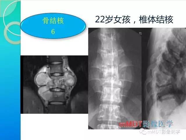 【PPT】不典型LCH诊断与鉴别诊断