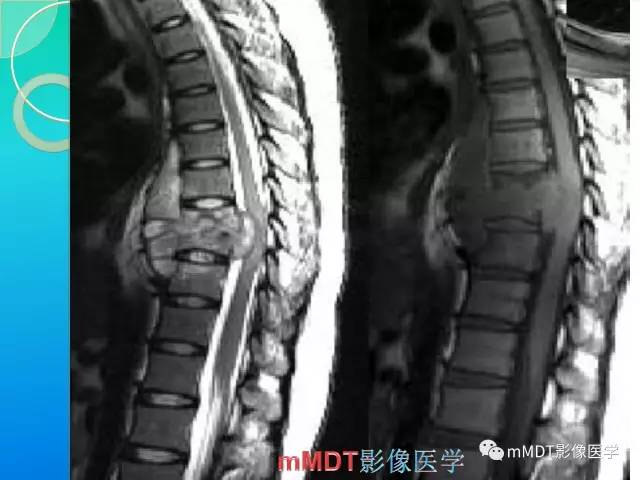 【PPT】不典型LCH诊断与鉴别诊断