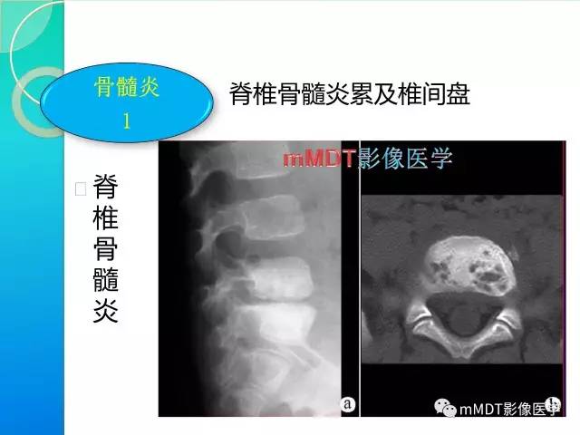 【PPT】不典型LCH诊断与鉴别诊断