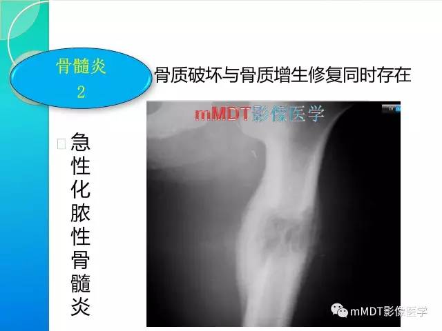 【PPT】不典型LCH诊断与鉴别诊断