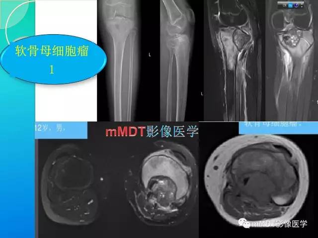 【PPT】不典型LCH诊断与鉴别诊断