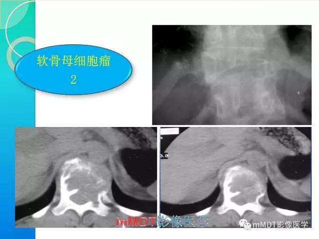 【PPT】不典型LCH诊断与鉴别诊断
