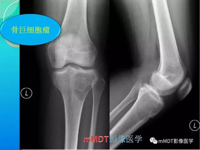 【PPT】不典型LCH诊断与鉴别诊断