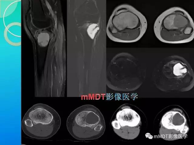 【PPT】不典型LCH诊断与鉴别诊断
