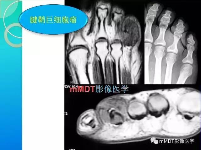 【PPT】不典型LCH诊断与鉴别诊断