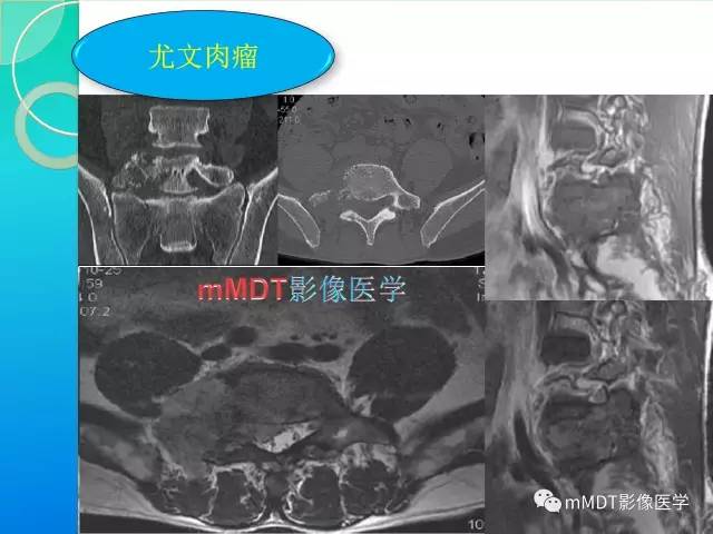 【PPT】不典型LCH诊断与鉴别诊断