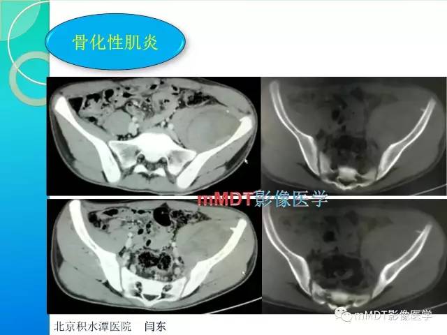 【PPT】不典型LCH诊断与鉴别诊断