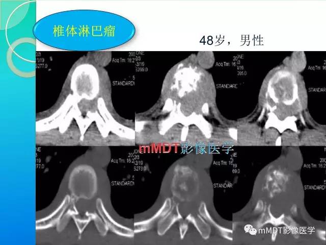 【PPT】不典型LCH诊断与鉴别诊断