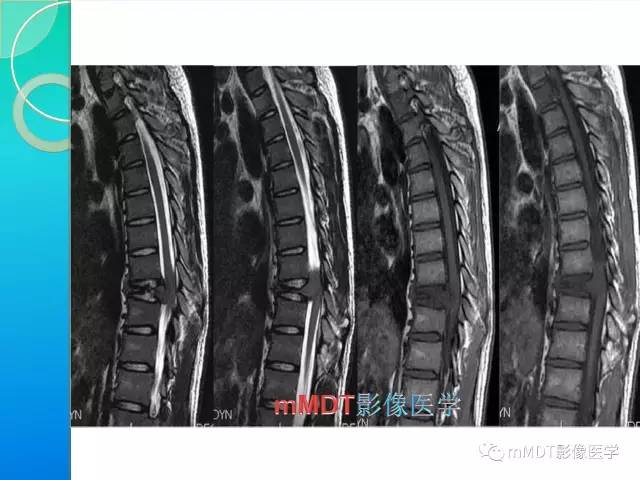 【PPT】不典型LCH诊断与鉴别诊断