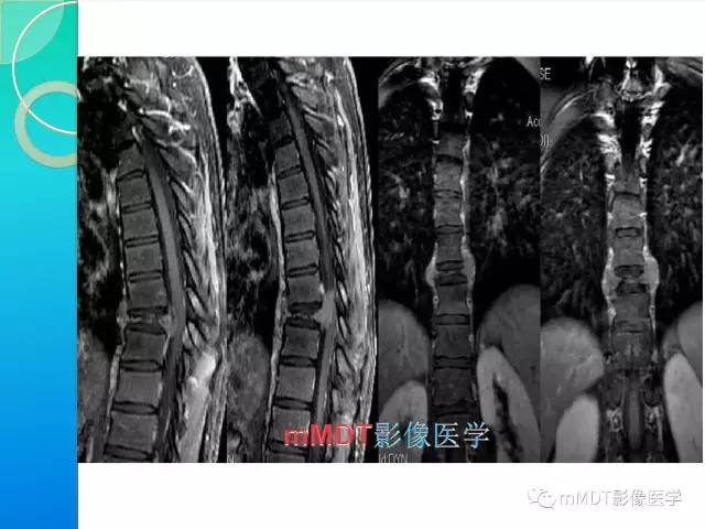 【PPT】不典型LCH诊断与鉴别诊断