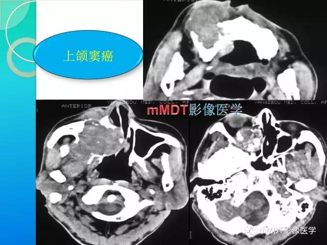 【PPT】不典型LCH诊断与鉴别诊断