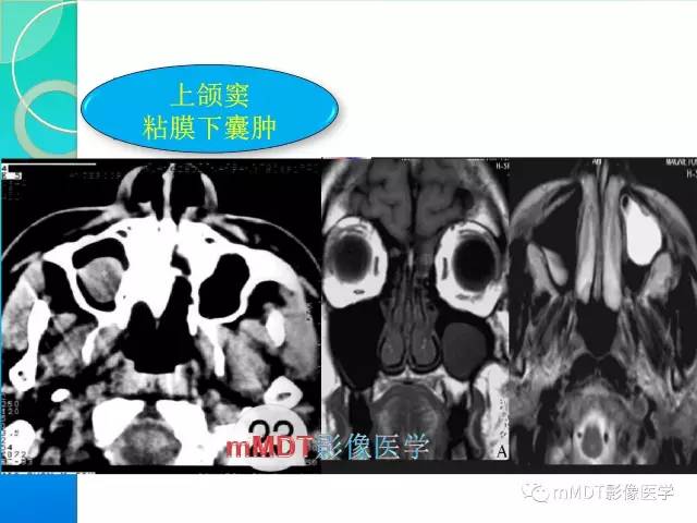 【PPT】不典型LCH诊断与鉴别诊断
