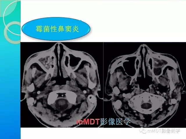 【PPT】不典型LCH诊断与鉴别诊断