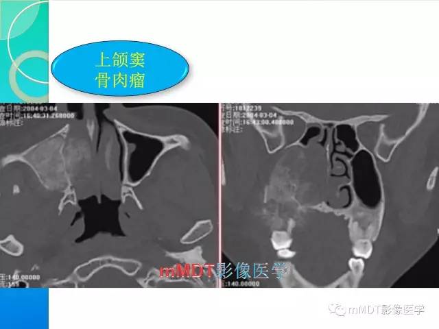 【PPT】不典型LCH诊断与鉴别诊断