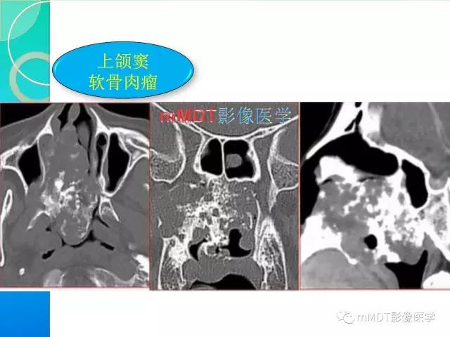 【PPT】不典型LCH诊断与鉴别诊断