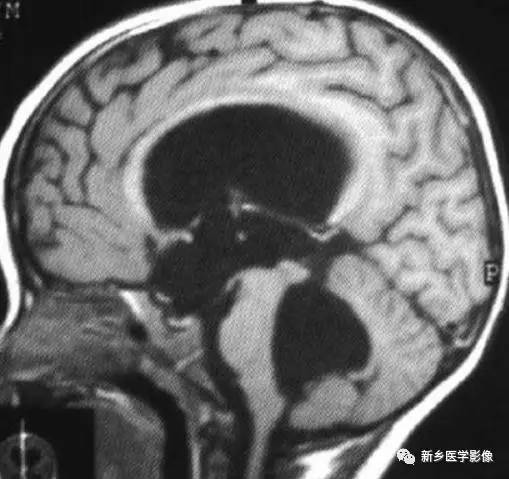 看到脑室内囊性病变,要想到这8种疾病 看到脑室内囊性病变,要想到这8种疾病