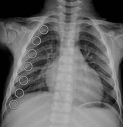 代谢性骨病的影像学表现：佝偻病和骨软化症Rickets and Osteomalacia