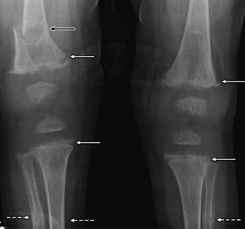 代谢性骨病的影像学表现:佝偻病和骨软化症Rickets and Osteomalacia 代谢性骨病的影像学表现:佝偻病和骨软化症Rickets and Osteomalacia