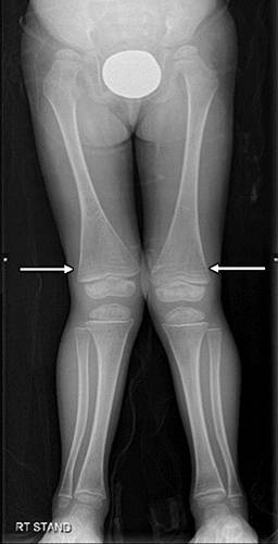 代谢性骨病的影像学表现:佝偻病和骨软化症Rickets and Osteomalacia 代谢性骨病的影像学表现:佝偻病和骨软化症Rickets and Osteomalacia